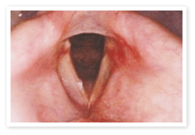 声帯ポリープで初めての全身麻酔