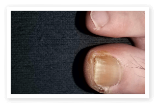 爪水虫。なかなか治らない!